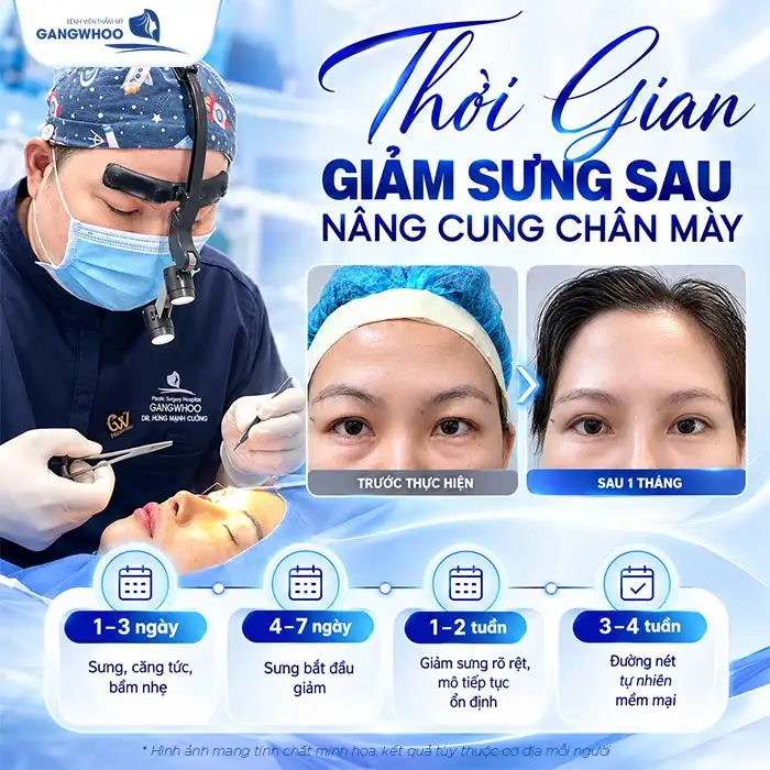Nâng Cung Chân Mày Bao Lâu Thì Hết Sưng? Tiến Trình Hồi Phục Chuẩn Y Khoa