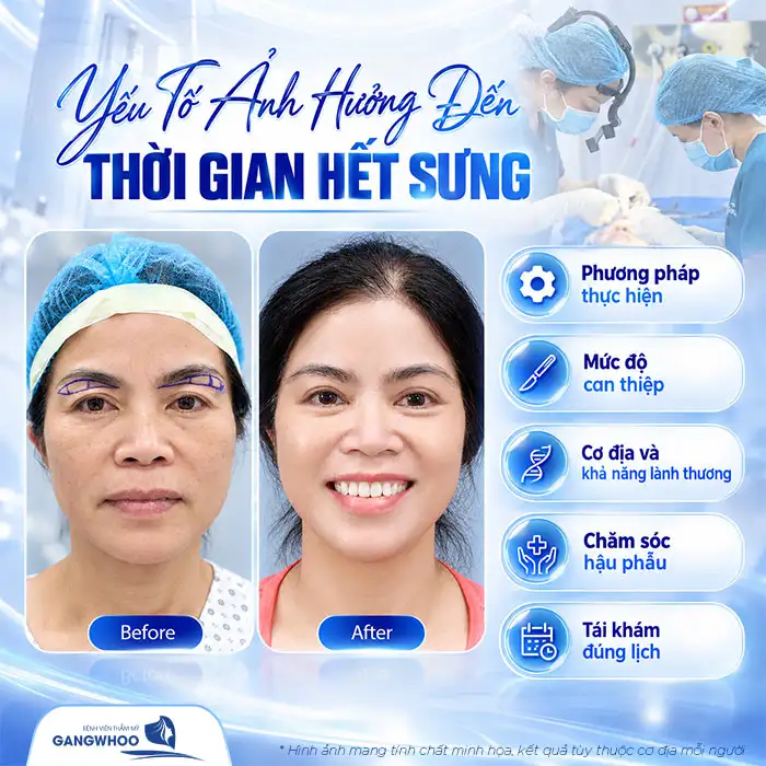 Nâng Cung Chân Mày Bao Lâu Thì Hết Sưng? Tiến Trình Hồi Phục Chuẩn Y Khoa