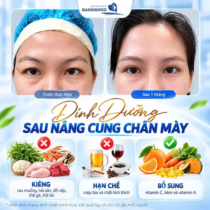 Nâng Cung Chân Mày Bao Lâu Thì Hết Sưng? Tiến Trình Hồi Phục Chuẩn Y Khoa