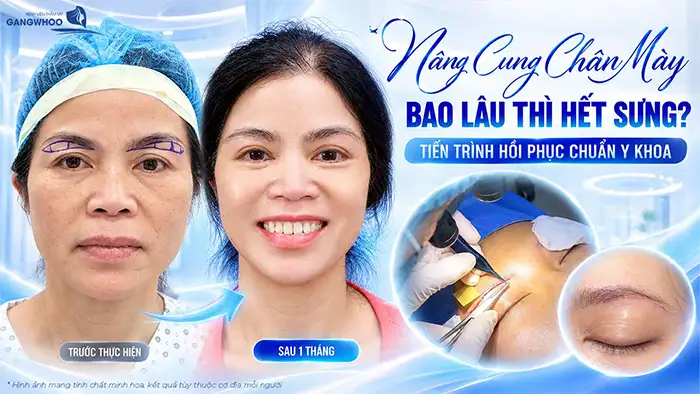Nâng Cung Chân Mày Bao Lâu Thì Hết Sưng? Tiến Trình Hồi Phục Chuẩn Y Khoa
