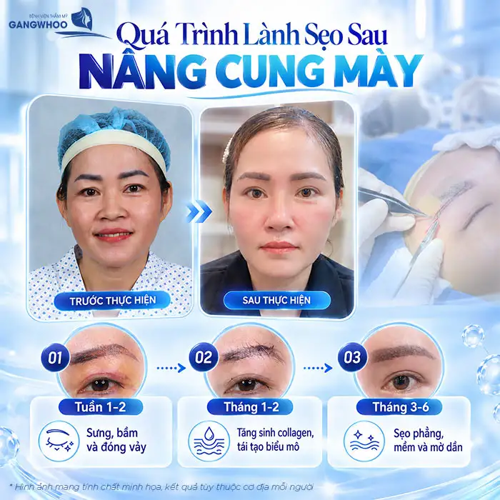 Nâng Cung Chân Mày Có Để Lại Sẹo Không? Góc Nhìn Chuyên Khoa Thẩm Mỹ