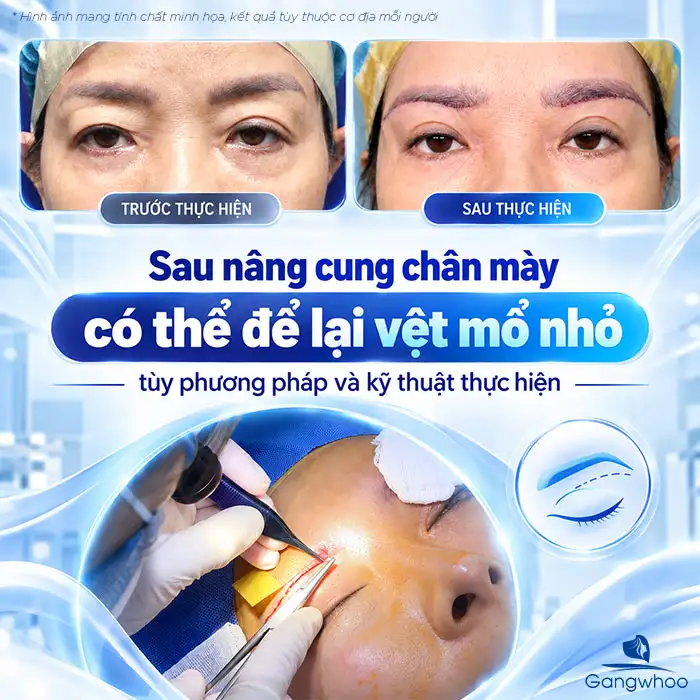 Nâng Cung Chân Mày Có Để Lại Sẹo Không? Góc Nhìn Chuyên Khoa Thẩm Mỹ