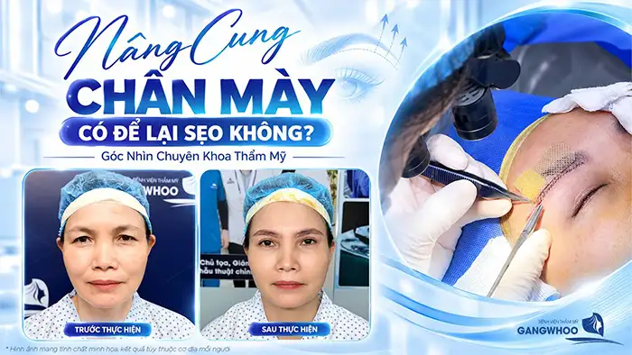 Nâng Cung Chân Mày Có Để Lại Sẹo Không? Góc Nhìn Chuyên Khoa Thẩm Mỹ