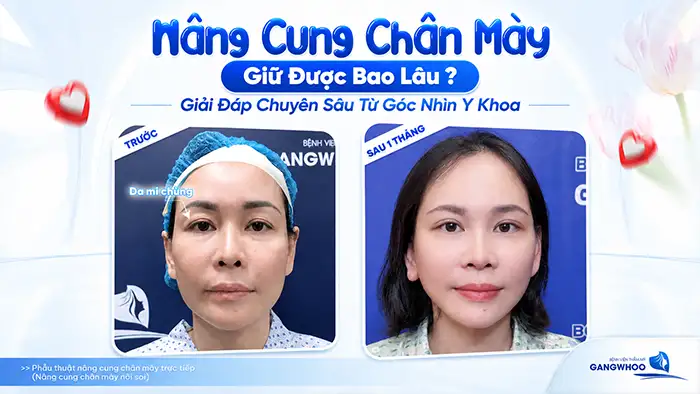 Nâng Cung Chân Mày Giữ Được Bao Lâu? Giải Đáp Chuyên Sâu Từ Góc Nhìn Y Khoa