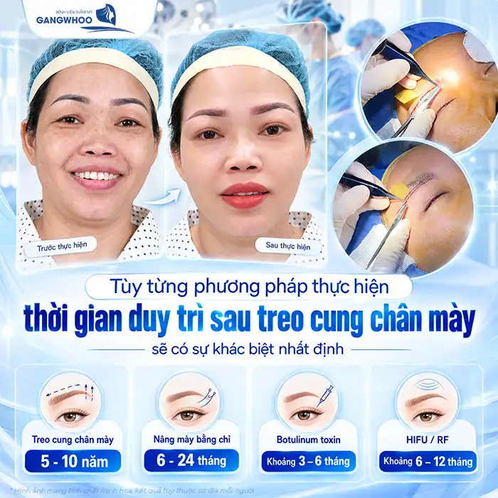 Nâng Cung Chân Mày Giữ Được Bao Lâu? Giải Đáp Chuyên Sâu Từ Góc Nhìn Y Khoa