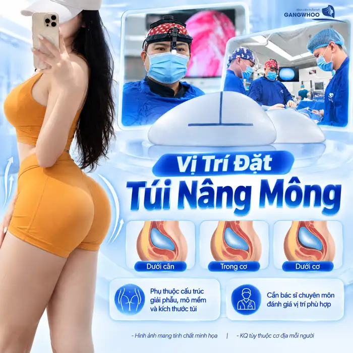 Túi Nâng Mông Là Gì? Các Loại, Độ An Toàn Và Những Điều Cần Biết