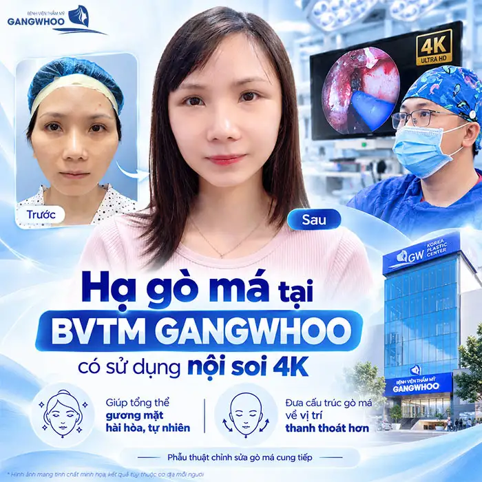 Hạ Gò Má Có Bị Xệ Mặt Không? Chuyên Gia Giải Đáp
