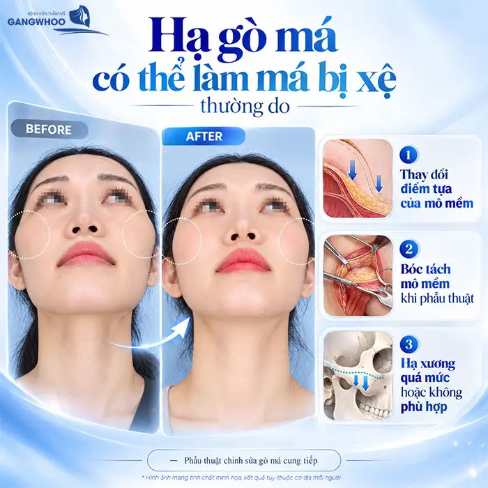 Hạ Gò Má Có Bị Xệ Mặt Không? Chuyên Gia Giải Đáp