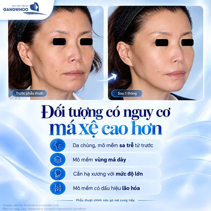 Hạ Gò Má Có Bị Xệ Mặt Không? Chuyên Gia Giải Đáp