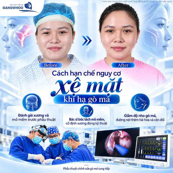 Hạ Gò Má Có Bị Xệ Mặt Không? Chuyên Gia Giải Đáp
