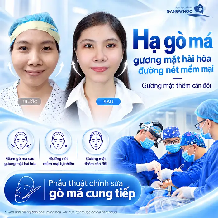 Hạ Gò Má Có Bị Xệ Mặt Không? Chuyên Gia Giải Đáp