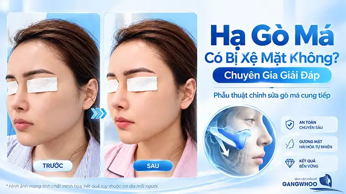 Hạ Gò Má Có Bị Xệ Mặt Không? Chuyên Gia Giải Đáp