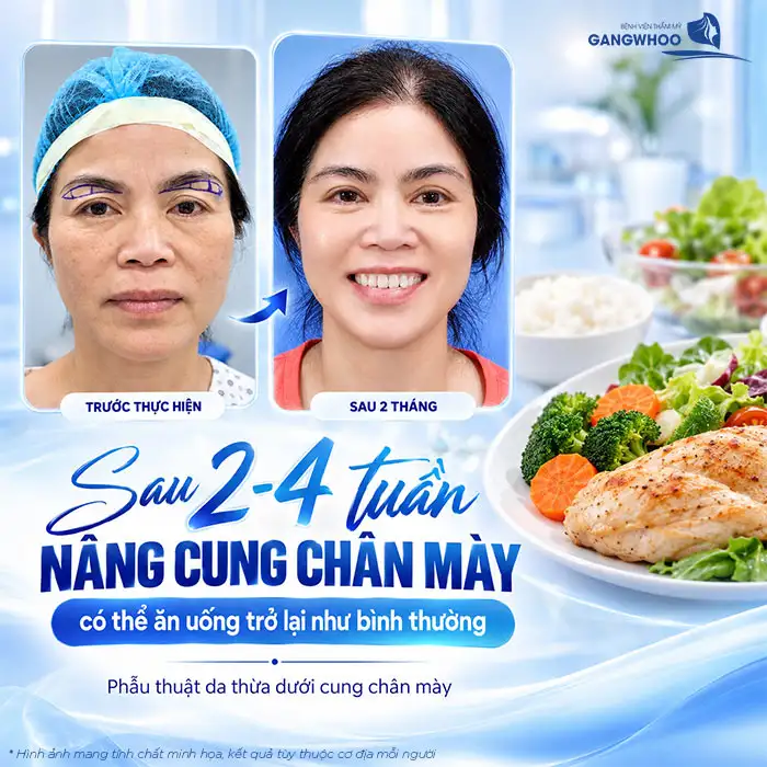 Nâng Cung Chân Mày Kiêng Ăn Gì Để Nhanh Lành, Không Để Lại Sẹo?