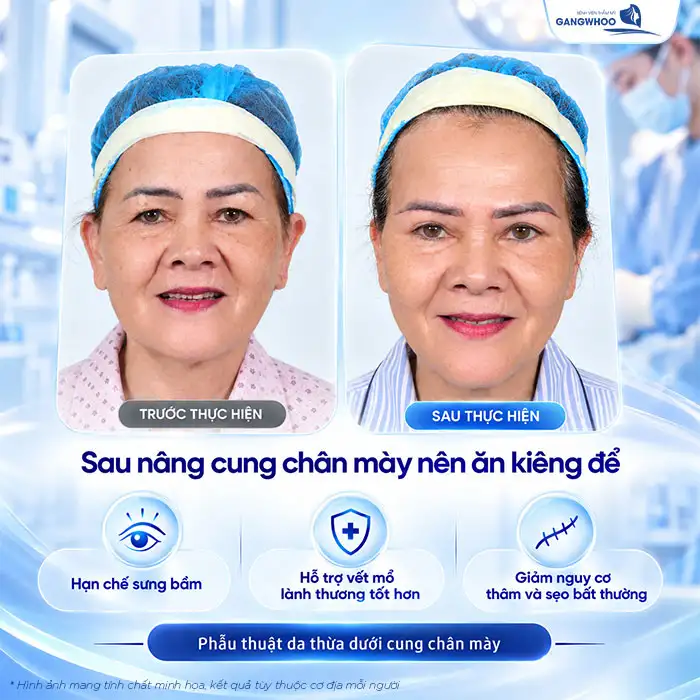 Nâng Cung Chân Mày Kiêng Ăn Gì Để Nhanh Lành, Không Để Lại Sẹo?